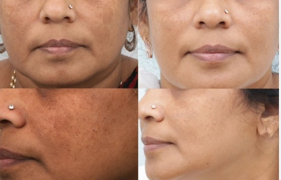 Hair Restoration Before After